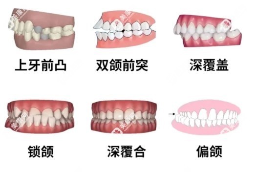 广州广大口腔GA数字化正畸技术