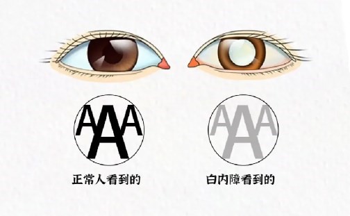   必看！2025年新疆治疗白内障手术需要多少钱？硬核对比国产/进口晶体价格差3倍