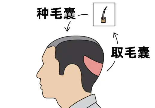 “植发三年真实感受”：告别秃顶，亲测植发靠谱的真实体验分享