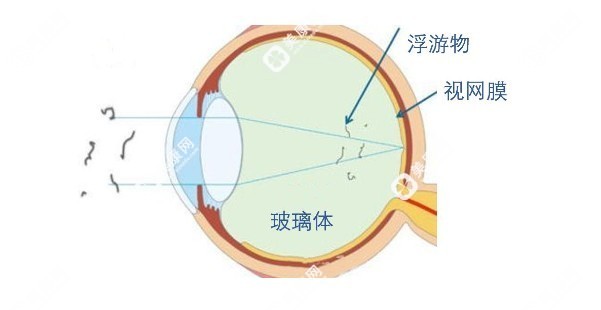 玻璃体浮游物