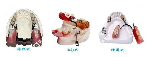 精密附着体无挂钩假牙价格slzxedu.com