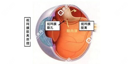 视网膜裂孔
