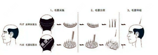 脂溢性脱发可通过植发手术恢复发量