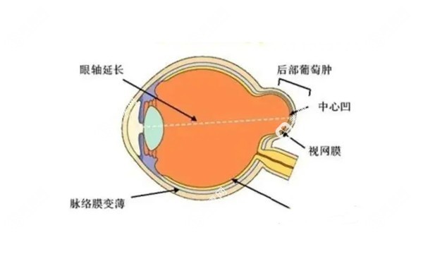 后巩膜加固术多大孩子可以做