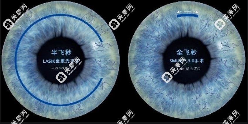近视眼手术全飞秒和半飞秒都能做哪个更好