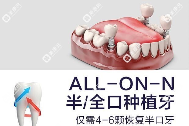 半口all-on-4种植牙价格4万元起