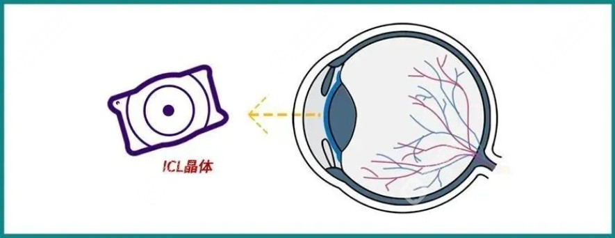 要减少ICL手术可能带来的潜在损伤