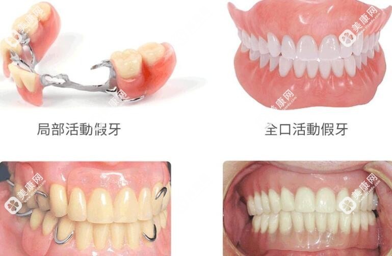 40岁中年人种牙也可以用活动假牙修复