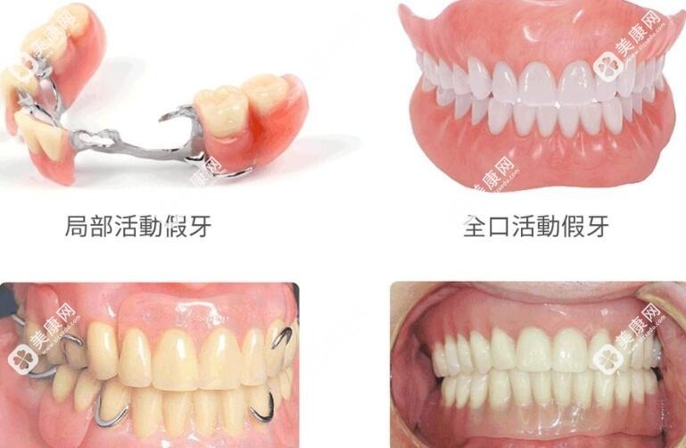 40歲中年人種牙也可以用活動假牙修復(fù)