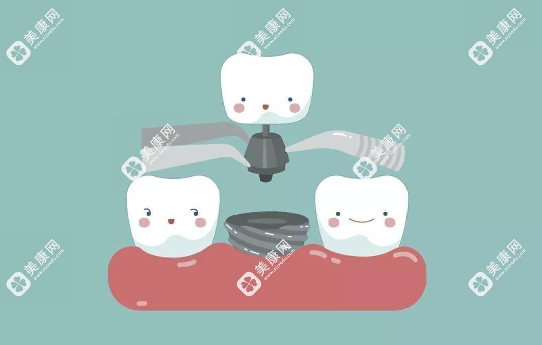 get不影响核磁共振及ct检查的种植牙材质选择建议