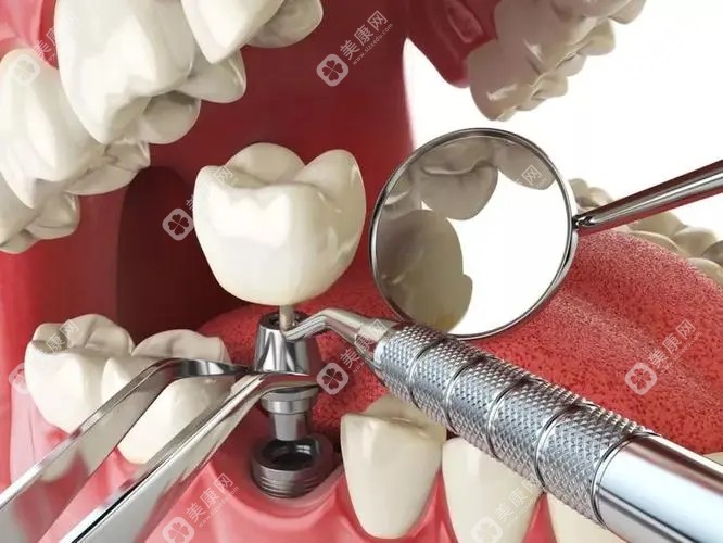 如何选择合适的种植牙医院