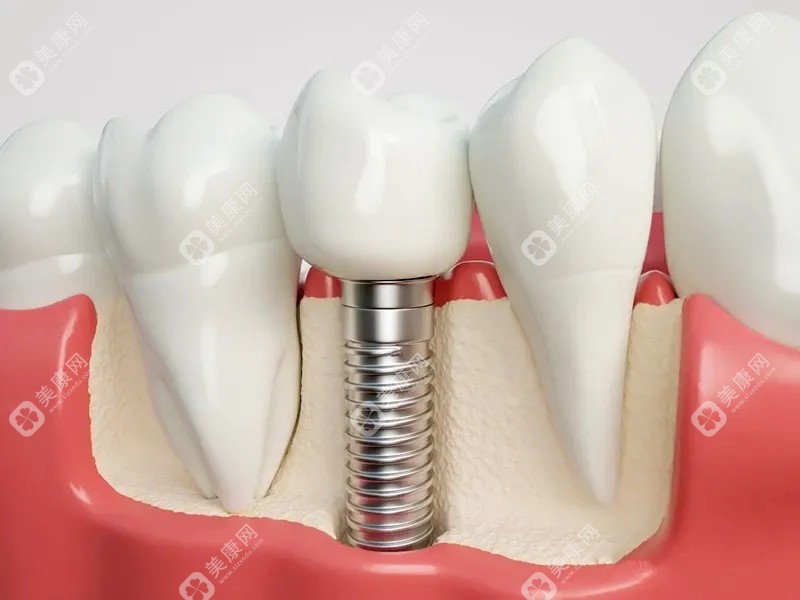 正规医院的种植牙收费标准