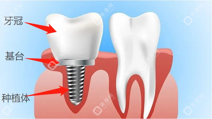 种植牙结构示意图www.slzxedu.com