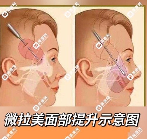 微拉美4.0的優(yōu)勢