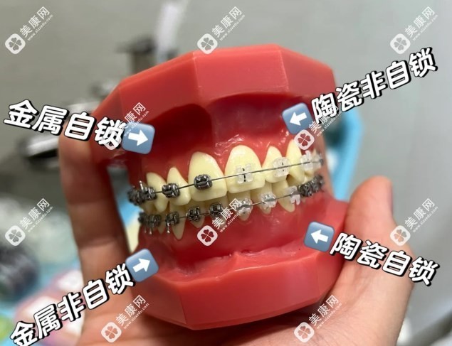 正规医院牙科牙齿矫正多少钱