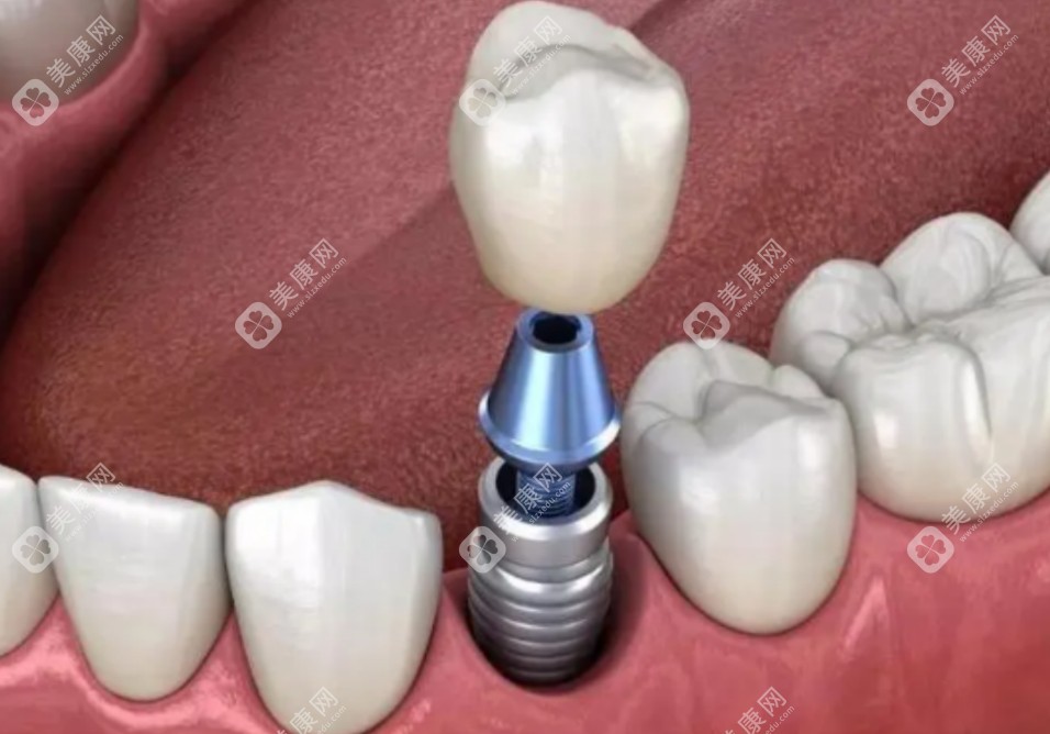 种植牙手术示意图