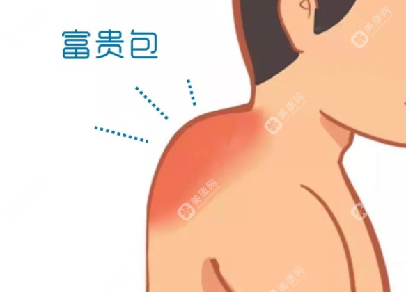 黃學(xué)峰一針消除富貴包靠譜么