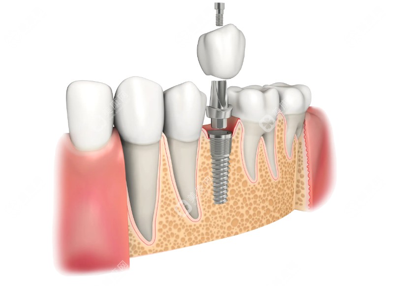种植牙结构示意图