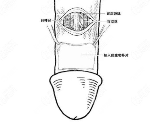 男性生物补片是骗局吗?技术很成熟不是骗局,也不会影响生育