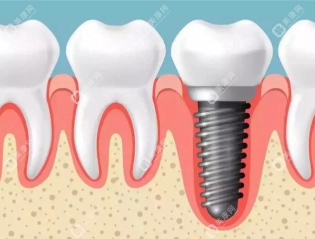 种植牙价格