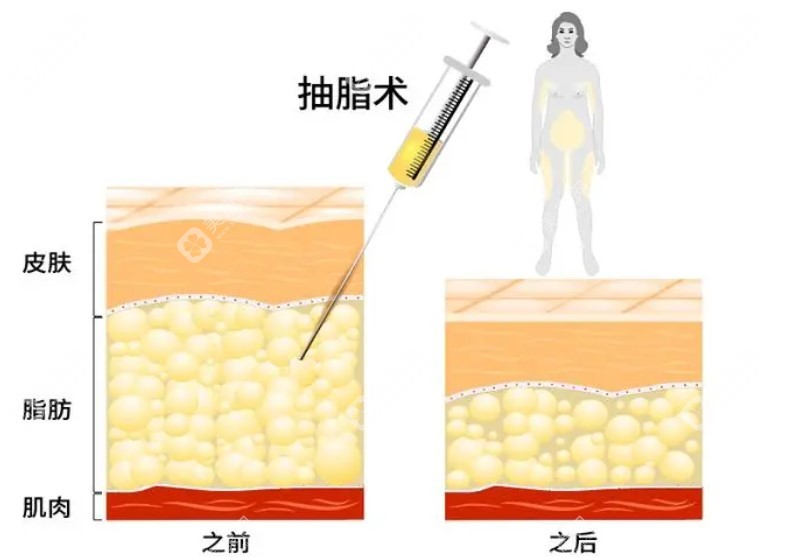 重庆抽脂好的医院排名 m.slzxedu.com