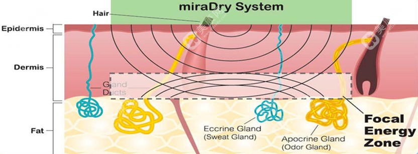 miradry清新微波真的有用!可以根除狐臭,并非骗局哦