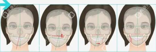 广州偏颌正颌手术医院排名|广州偏颌正颌手术广大医院好还不贵