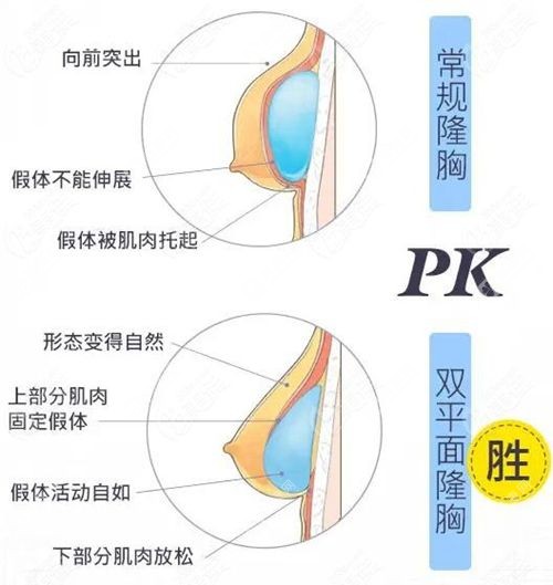 穆大力隆胸价格表