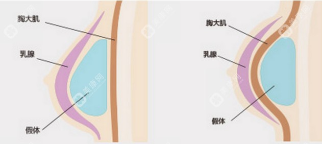 幸蕴无痕丰胸多少钱一次2025？大概价格2-5万元起,不是营销挺靠谱的