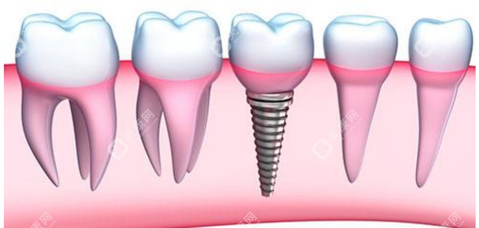 【正规医院种植牙收费标准】私立口腔全口种植牙16颗大概10万起