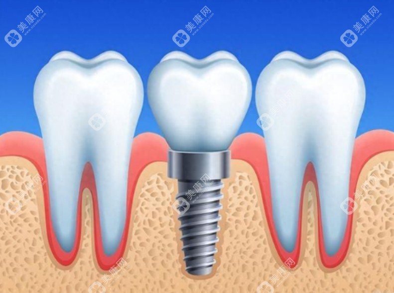 鼎植口腔种植牙价格