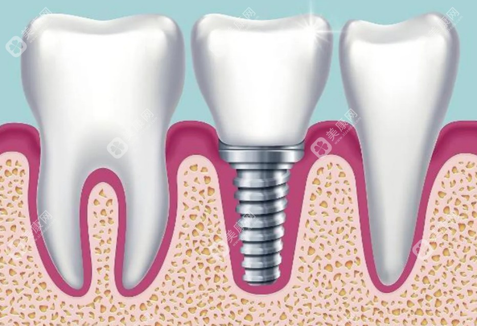 正规口腔医院种植牙价格