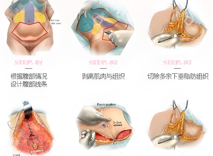 腹壁整形手术过程