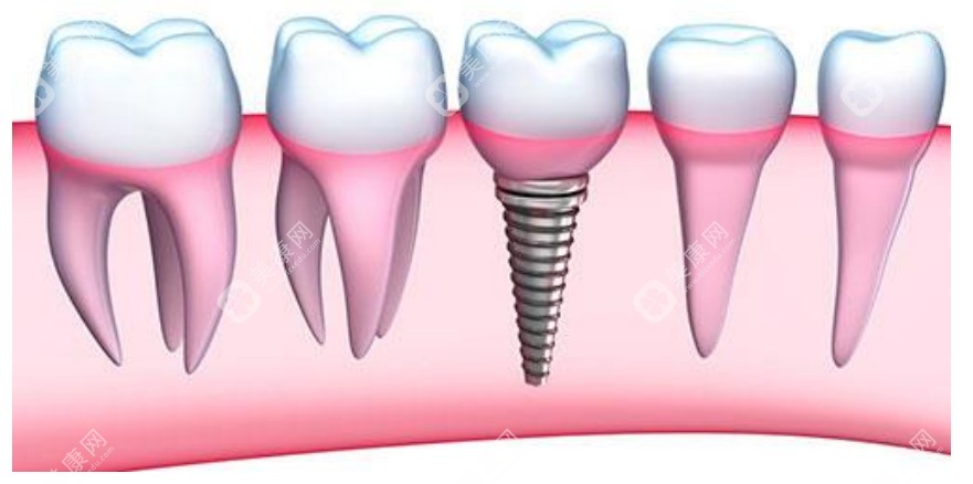鼎植口腔种植牙价格