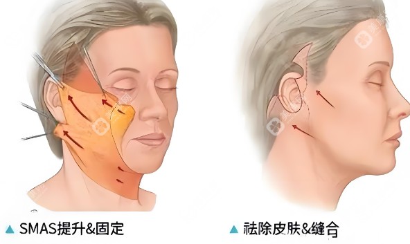 国内拉皮手术医院排名榜前50良心机构汇总(2025面部提升市场均价40530元)