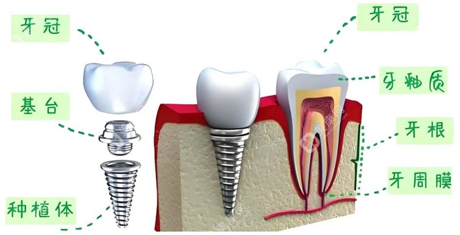 种植牙手术示意图slzxedu.com