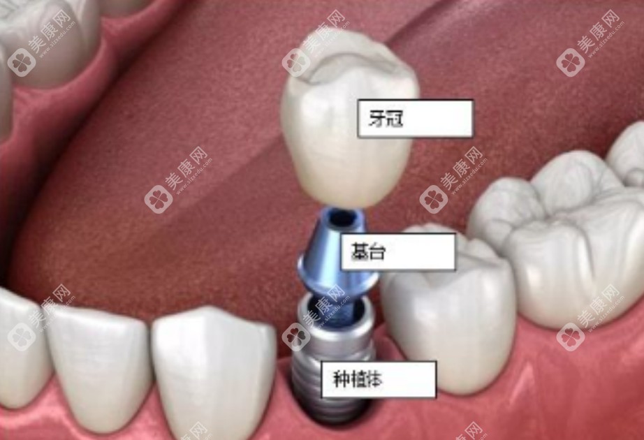 种植牙手术示意图