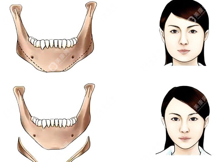 北京下颌角磨骨手术医院医生排名www.slzxedu.com