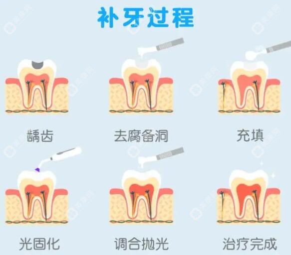 廊坊补牙收费