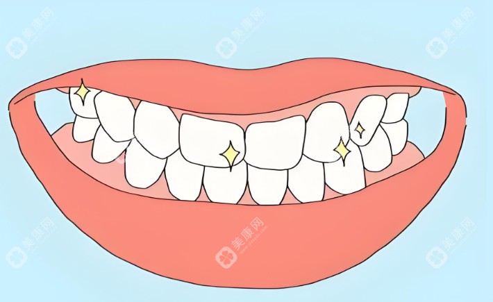 【牙贴面多少钱一颗2025价格表】300元起,爱尔创比美加超薄贴面便宜