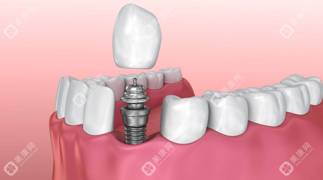 【种植牙多少钱一颗2025价格表】今日揭晓我国种植牙价格一览表2025