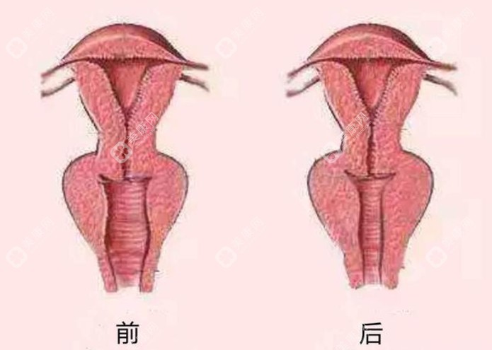 广州私密紧缩手术好的医院做私密紧缩手术成效好