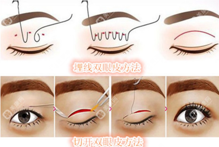 郑小红医生做双眼皮手术