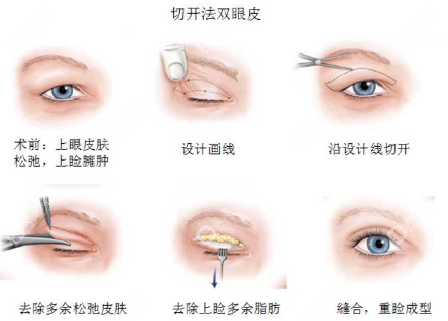 郑小红医生双眼皮范例无黑料不失败，郑小红做双眼皮是真的好没有营销不是吹得