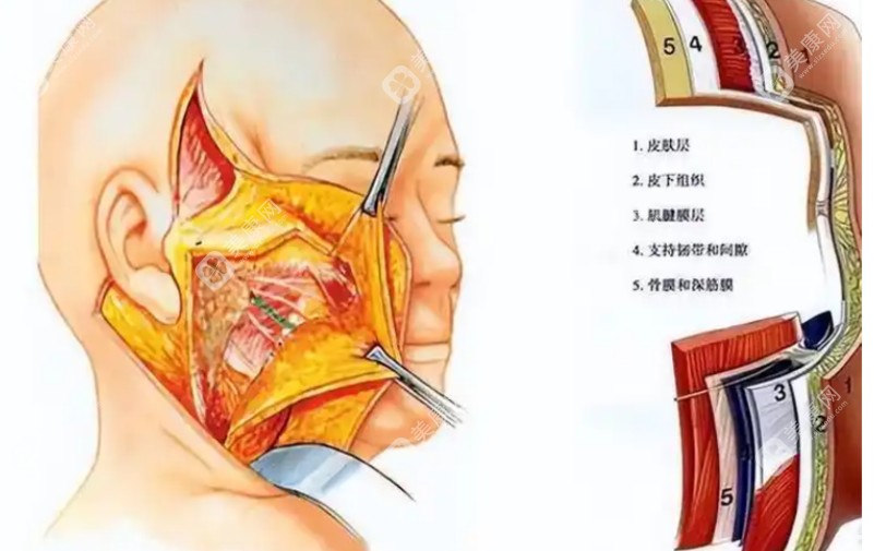 袁强医生做拉皮手术