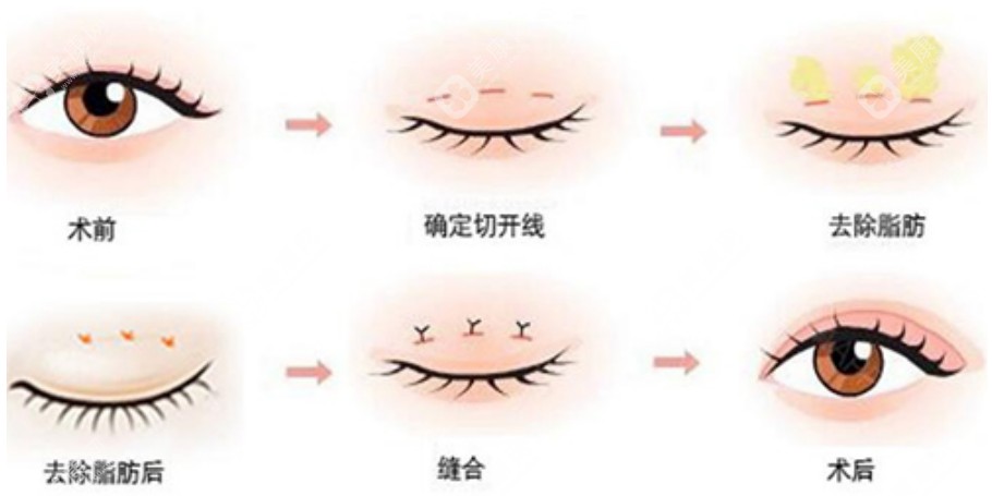 上海徐晓斐做双眼皮手术