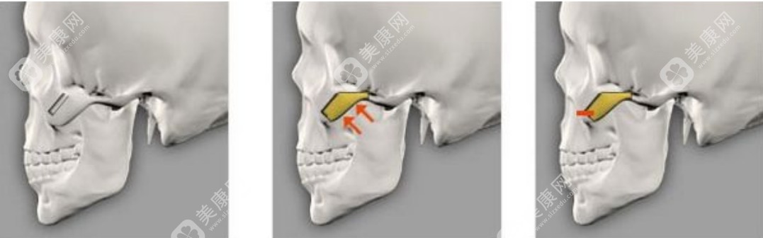 李继华医生磨骨 李继华医生磨骨