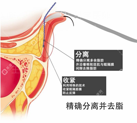 深圳健丽医美去眼袋当然正规！健丽医美不开刀祛眼袋费用19800元起成效好不坑人