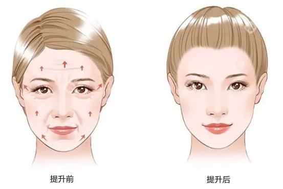 李建钢筋膜提升好不好?看50+姐姐去成都素美找李建钢做无痕筋膜提升真被安利了