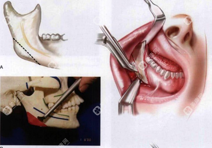 李继华医生磨骨 李继华医生磨骨